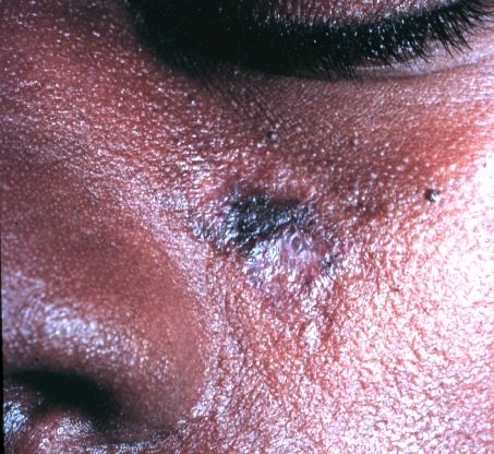 Clinical photograph of a chronic localized facial lesion documented as discoid lupus erythematosus. Вікімедія Коммонс
