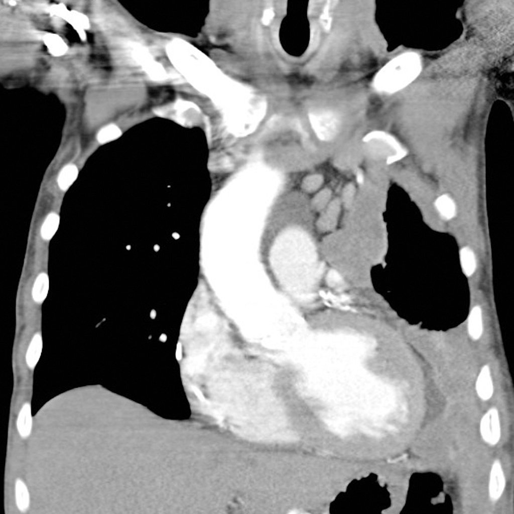 Coronal contrast-enhanced chest CT demonstrating extensive left pleural soft-tissue thickening encasing the lung with marked contraction of the hemithorax.