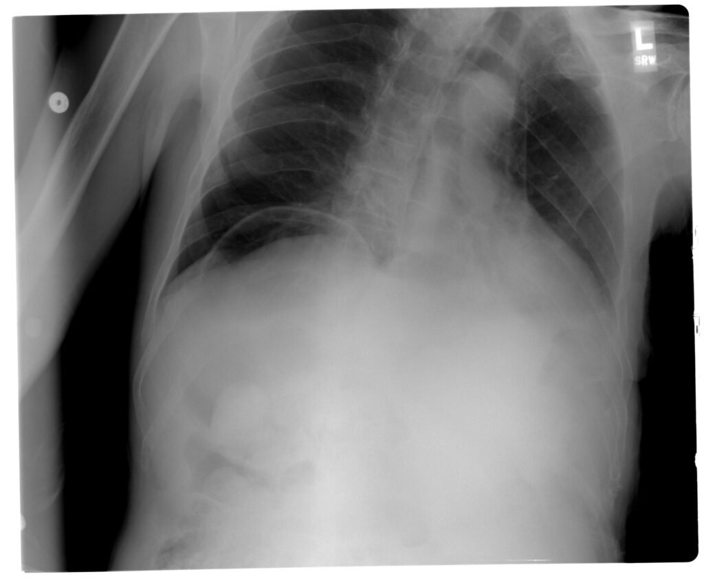 Upright chest radiograph demonstrating a crescent of free gas beneath the right hemidiaphragm.