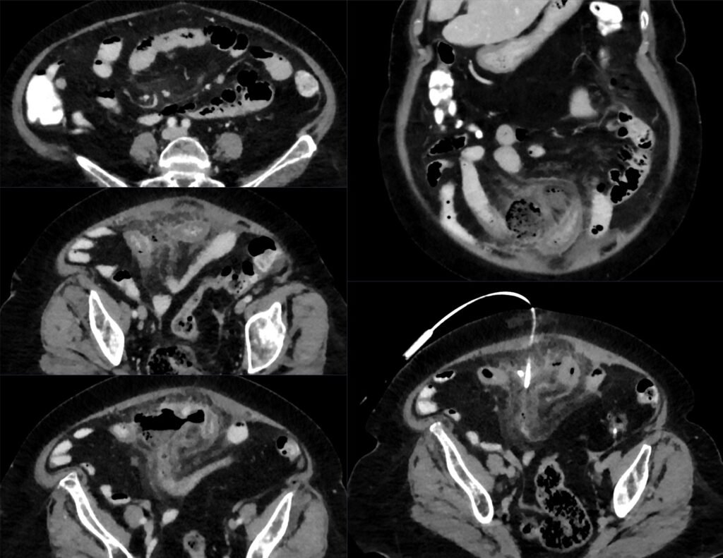 CT series showing a localized abscess associated with perforated small-bowel diverticulitis and subsequent catheter drainage.