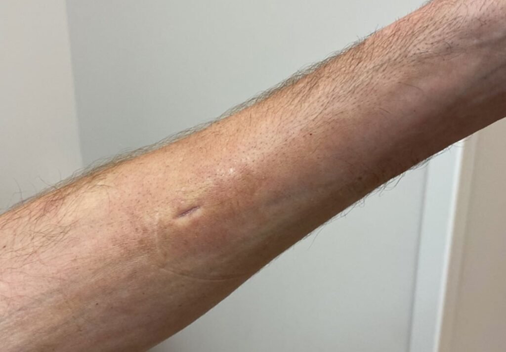 Clinical photograph showing a linear depression over a superficial forearm vein, the characteristic groove sign of eosinophilic fasciitis. Sitecore +1