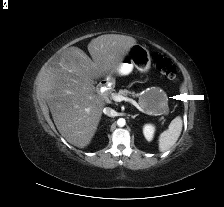 Pathological image of a pancreatic mucinous cystic neoplasm showing a multilocular mucin-producing cystic lesion.