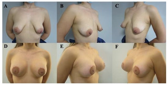 Standardized frontal and oblique clinical photographs showing a bilateral severe tuberous breast deformity before correction and the postoperative result.