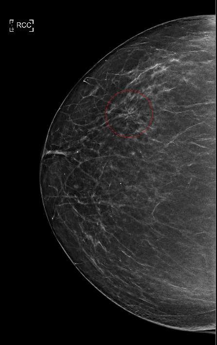 Craniocaudal mammogram showing a circled region of abnormal breast parenchymal architecture.
