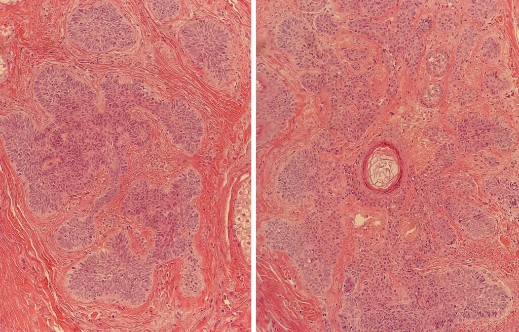Two hematoxylin-and-eosin sections obtained at different levels through the same hair-follicle region.