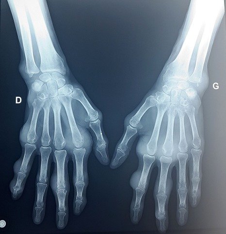 Bilateral hand radiographs demonstrating periarticular erosive abnormalities and soft-tissue swelling.