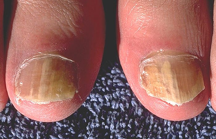 Both great toenails show yellow-brown discoloration, distal nail dystrophy, thickening, and subungual keratinous change.