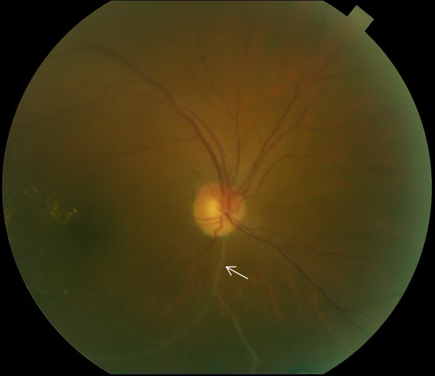 Color fundus photograph showing chronic retinal venous occlusive changes with a sclerosed branch retinal vein.