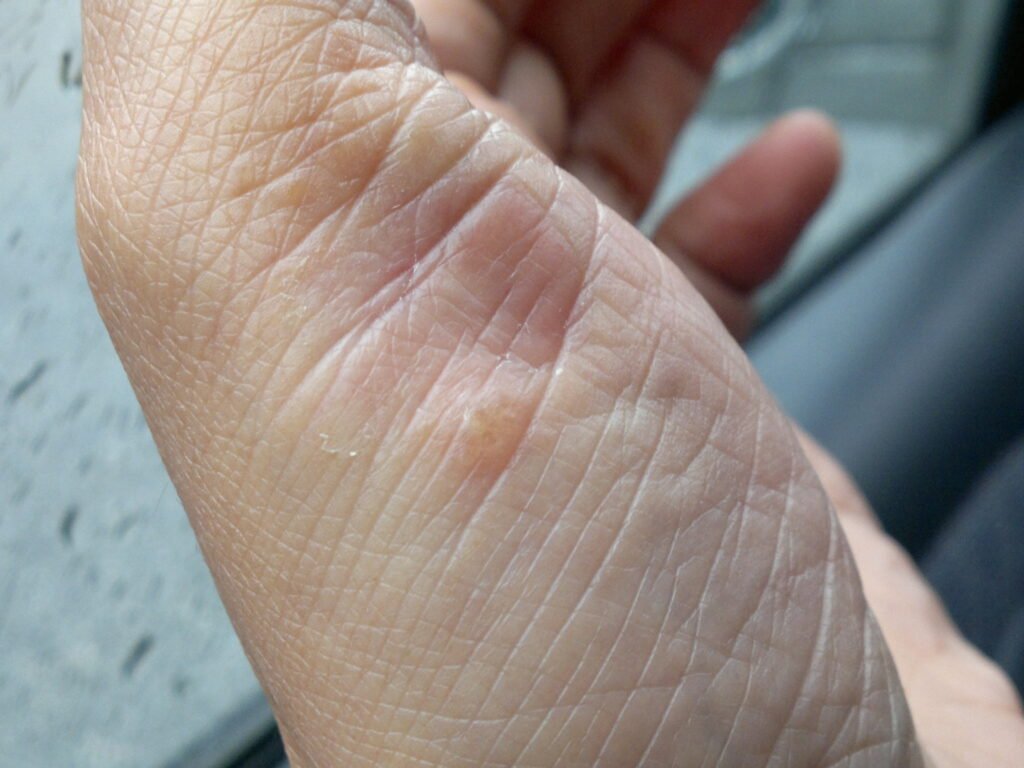 Clinical photograph documenting palmoplantar pustulosis with a pustular lesion on palmar skin. Вікімедія Коммонс +1