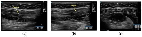 B-mode ultrasound images of the lower face and neck showing sagging platysma bands with only a small submental fat accumulation.